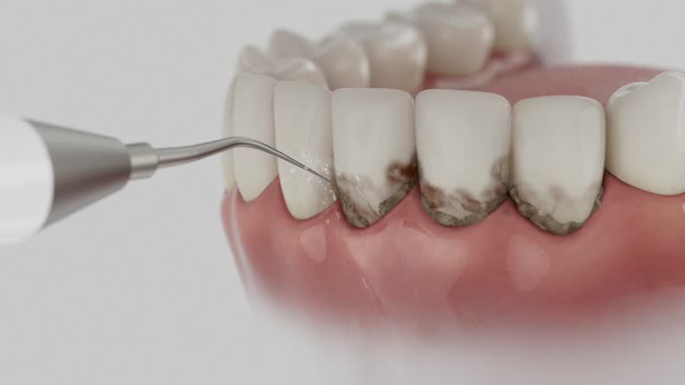 Trusted Wisdom Tooth Removal service in Montvale, NJ - Dentist Open Now